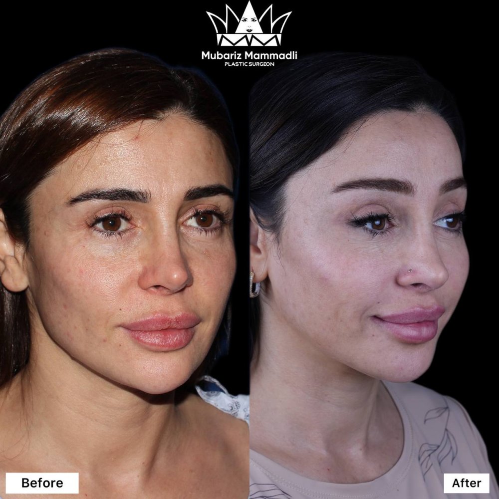 Endoscopic bella eyes surgery ; bella eyes ; fox eyes; plastic surgery; bella eyes əməliyyatı