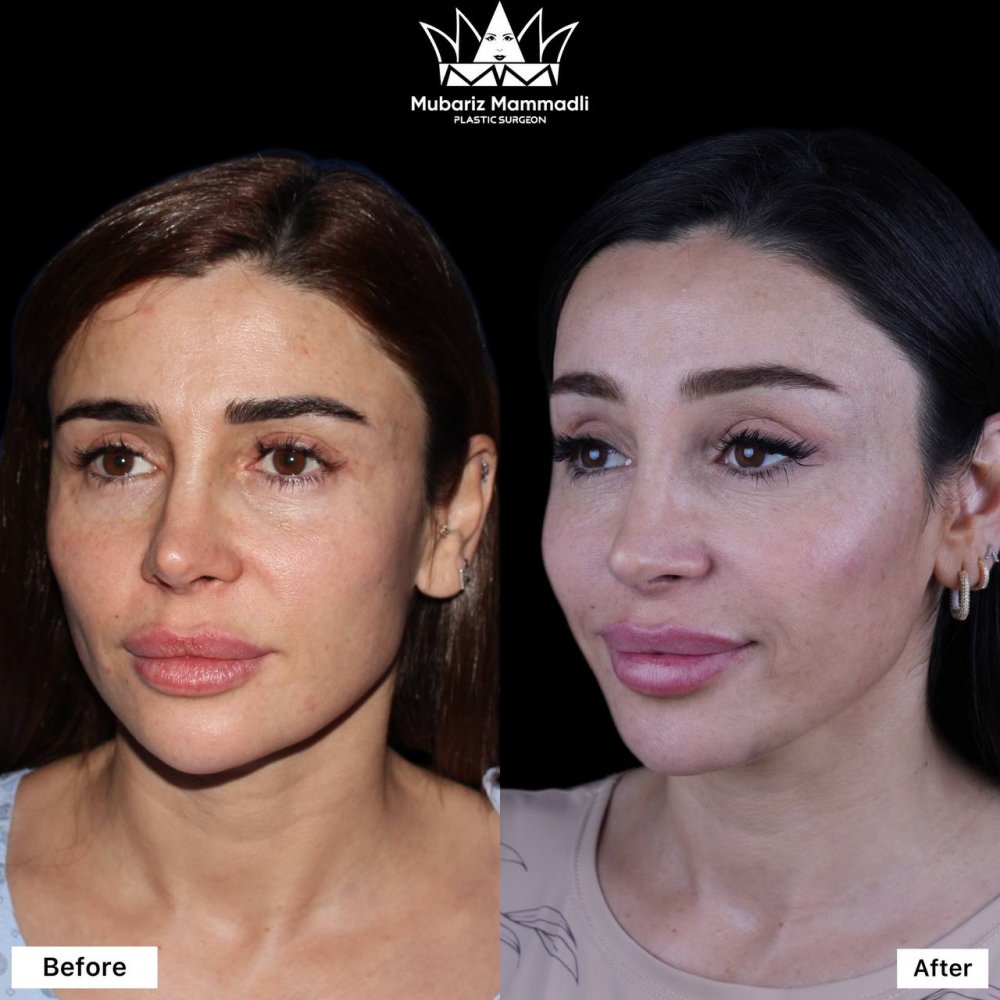 brow lift ; brow lift surgery ; qas qaldirma ; qaş qaldırma əməliyyatı ; plastic surgery ; plastik əməliyyat
