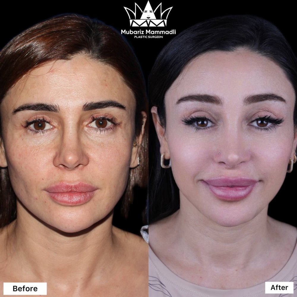 brow lift ; brow lift surgery ; qas qaldirma ; qaş qaldırma əməliyyatı ; plastic surgery ; plastik əməliyyat