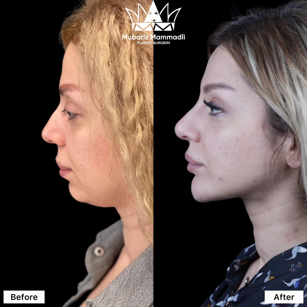 neck lift surgery; neck lift ; plastic surgery ; endoscopic surgery