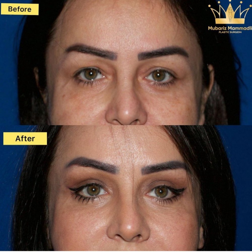 blepharoplasty ; plastic surgery ; upper blepharoplasty