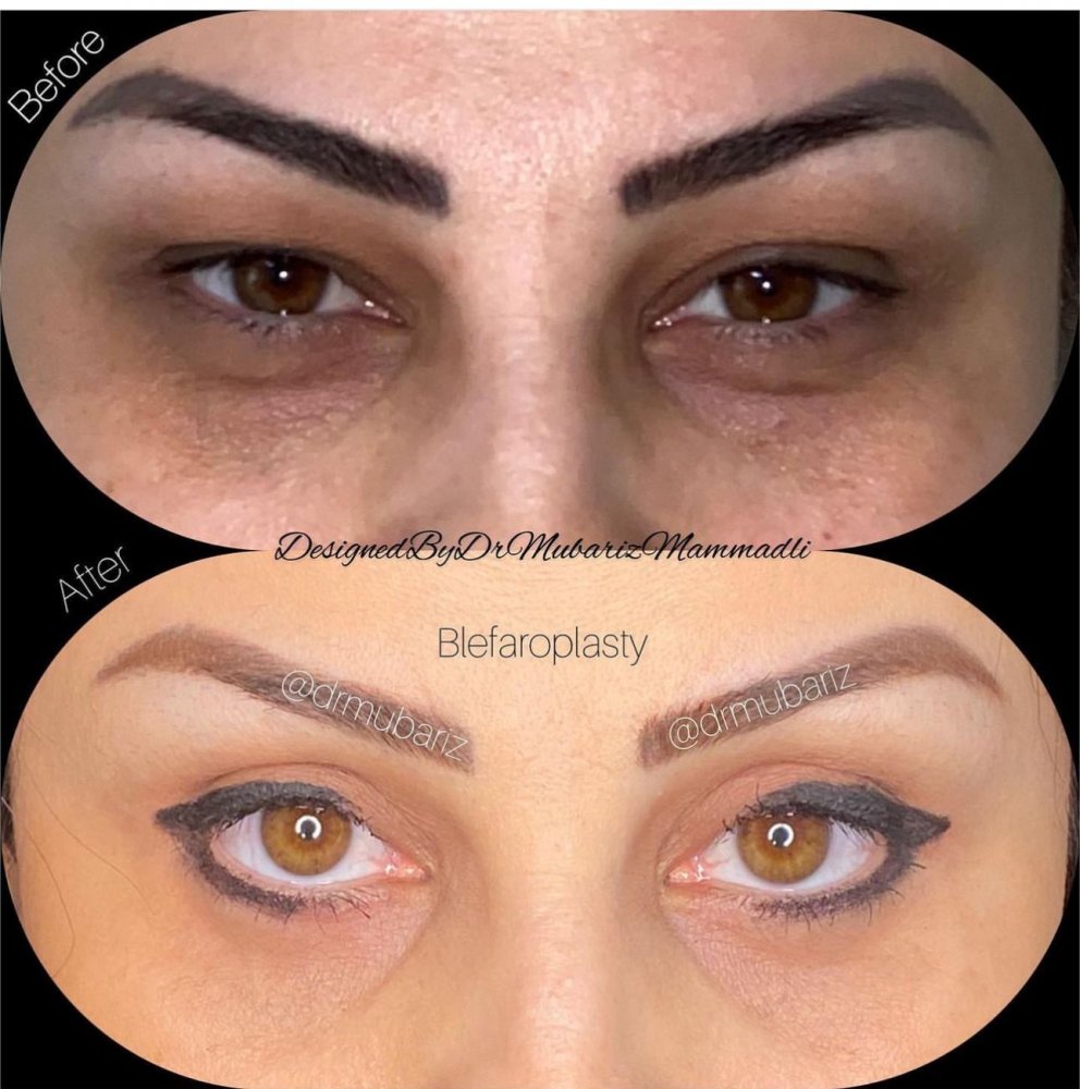 blepharoplasty ; plastic surgery ;