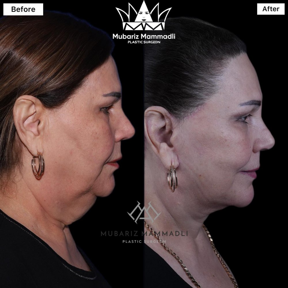 facelift ; facelift surgery ; plastic surgery