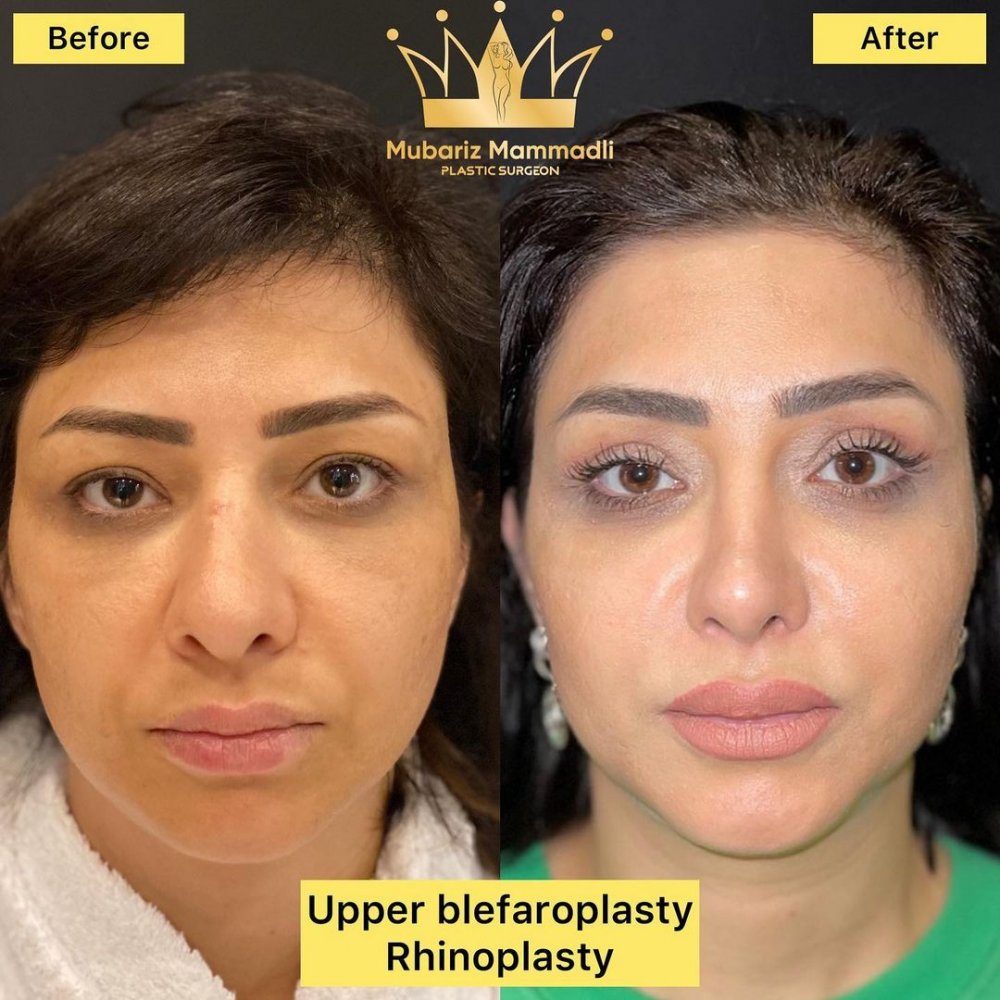 rinoplasty surgery