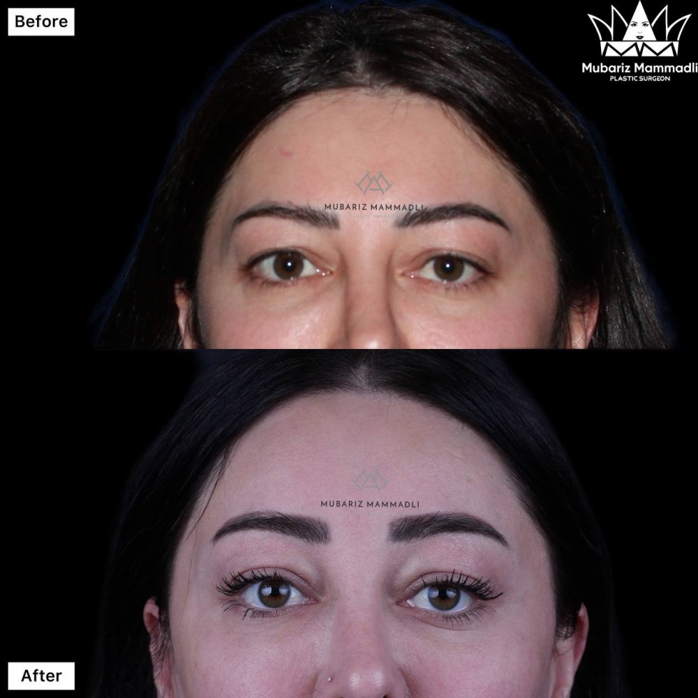 browlift surgery