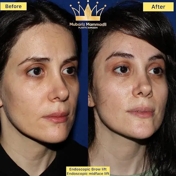 Endoscopic midface lift surgery