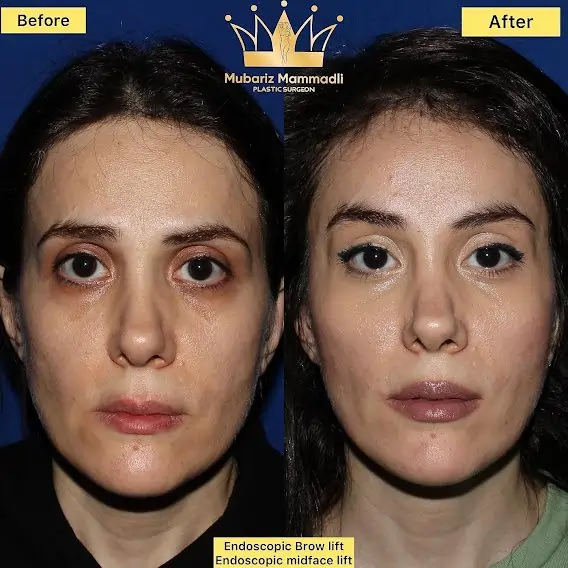 Endoscopic midface lift surgery