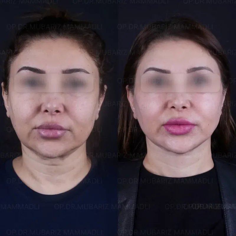 Deep Plane Facelift Before and After: What to Expect