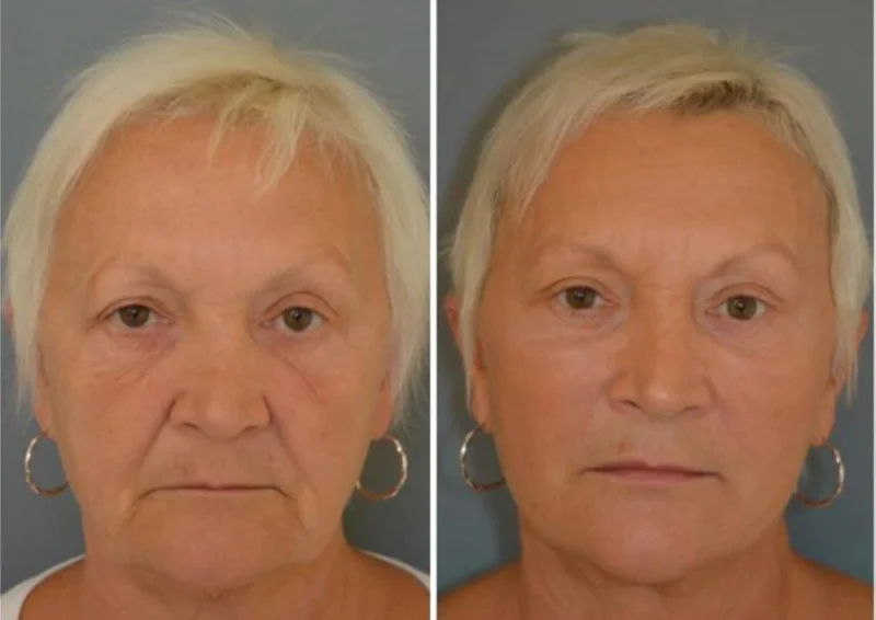 Nonsurgical Facelift: What It Is, Options & Benefits ✅