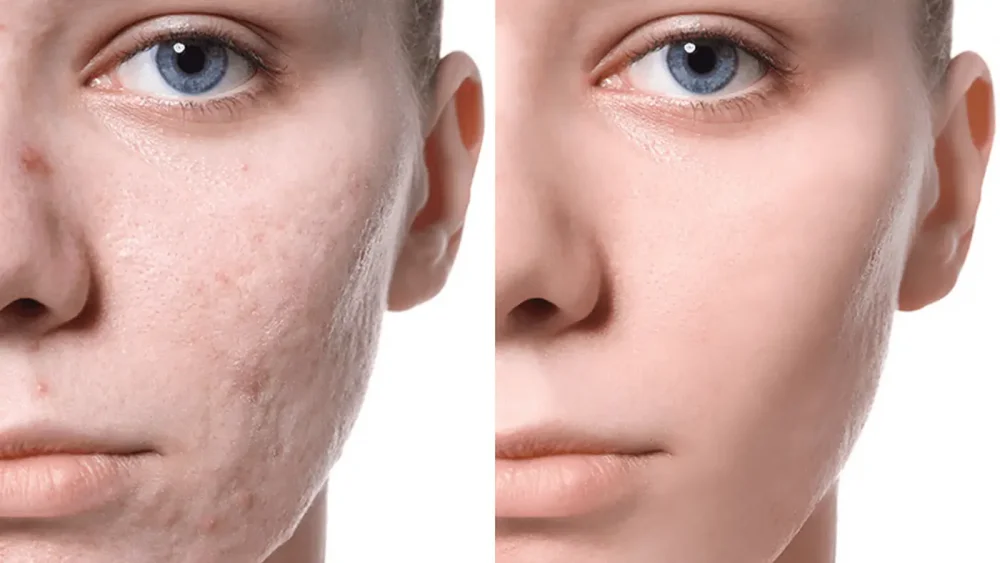 Scar removal surgery price in London