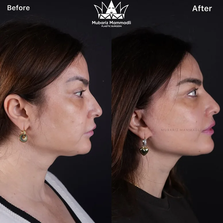 DEEP PLANE FACELIFT SURGERY BEFORE AND AFTER
