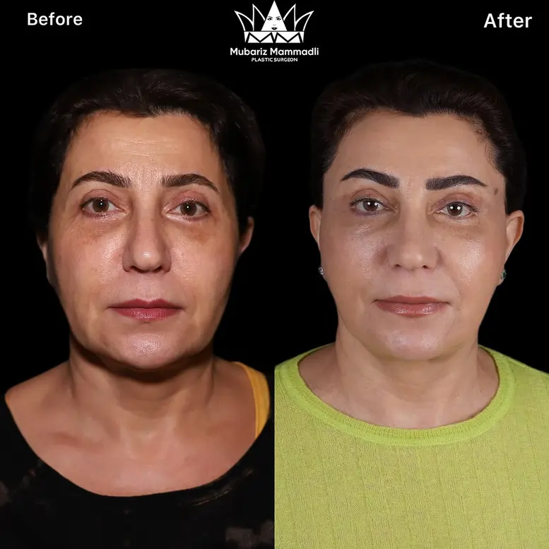 FACELIFT SURGERY BEFORE AFTER