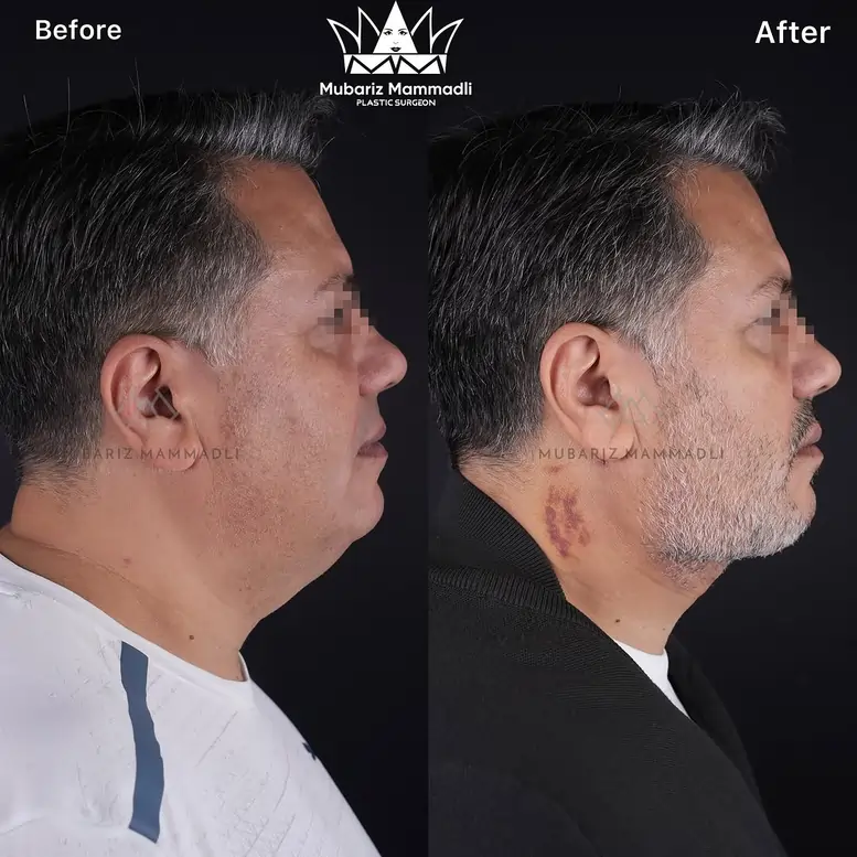 NECK LIFT BEFORE AFTER