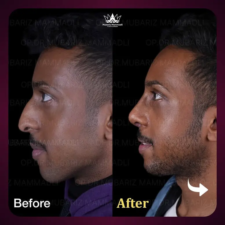 RHINOPLASY (Nose Surgery) & BLEPHAROPLASTY BEFORE AFTER SURGERY