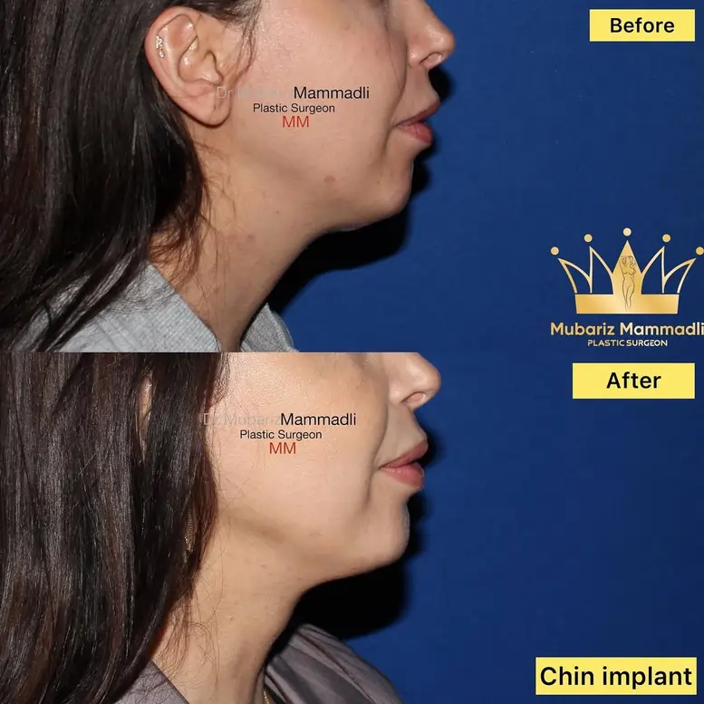 CHIN IMPLANT SURGERY