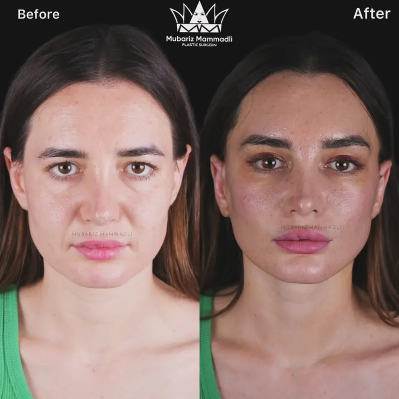 Endoscopic Brow Lift before and after