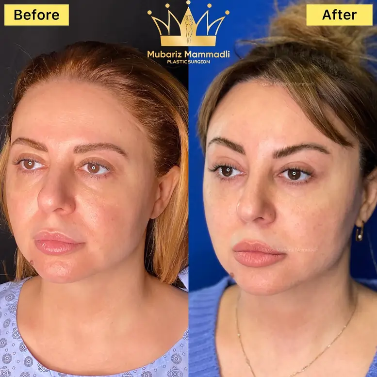 Endoscopic Brow Lift before and after