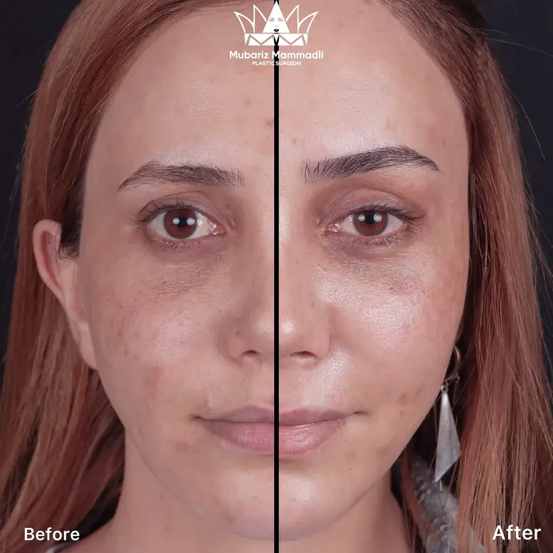 Endoscopic Brow Lift before and after results