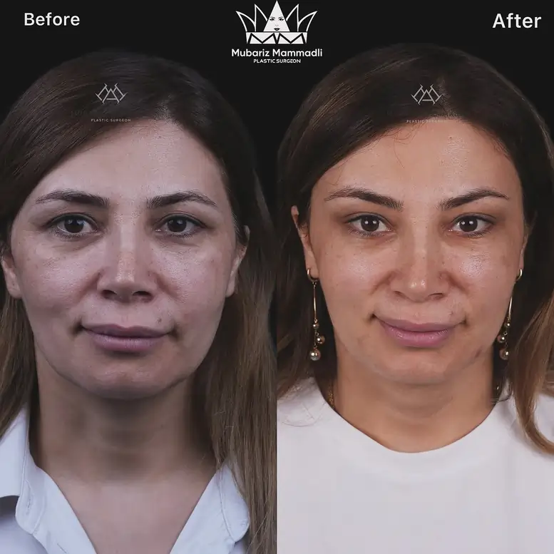 Bella Eyes Surgery cost, before after and more✅ bella eye surgery before after