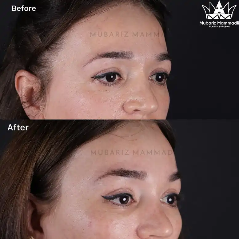 Bella Eyes Surgery cost, before after and more✅ bella eyes surgery before after