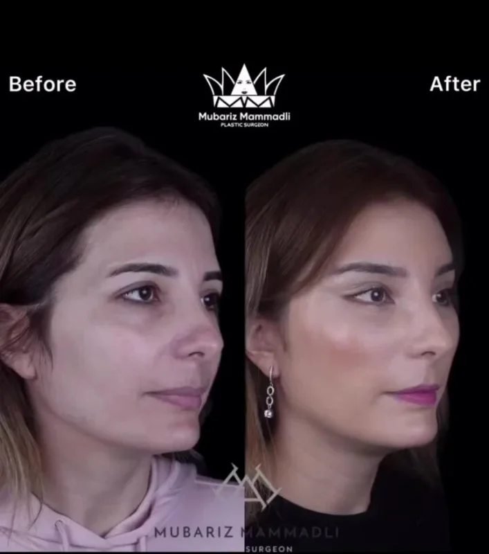 Bella Eyes Surgery cost, before and after bella eyes surgery before after