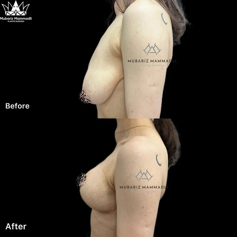 Breast Lift before and after