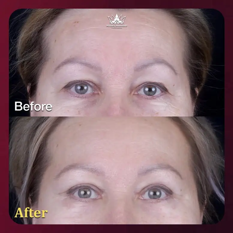Lower Blepharoplasty before after Lower Blepharoplasty cost