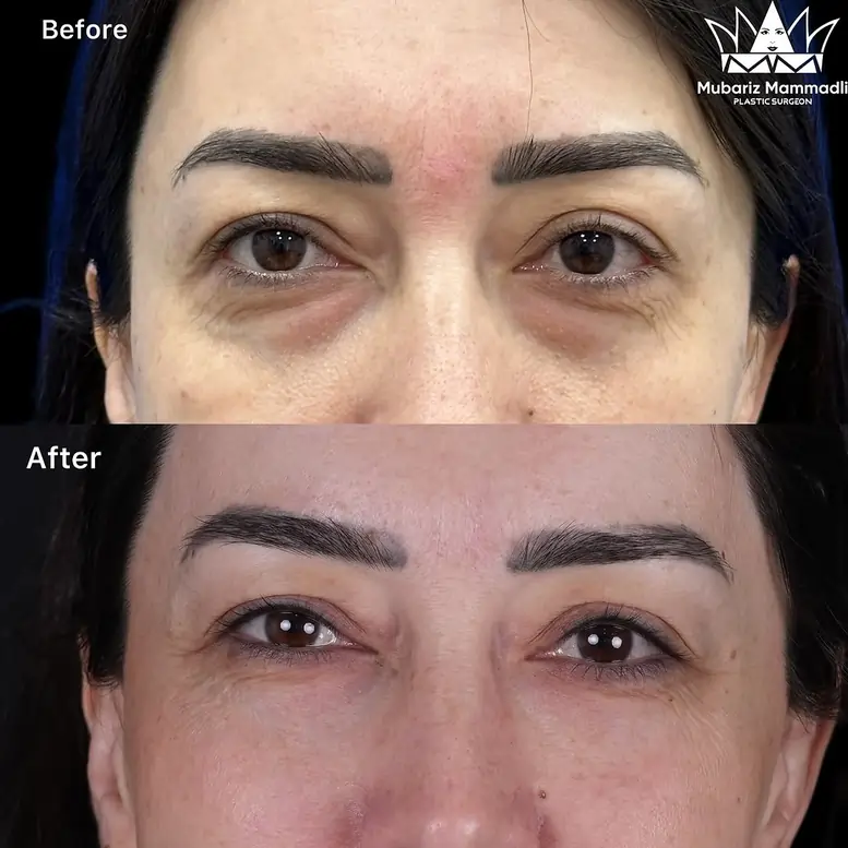 Lower Blepharoplasty before and after, cost & more