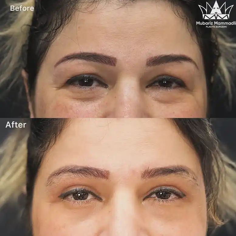 Upper Eyelid Blepharoplasty before and after Upper Blepharoplasty before after