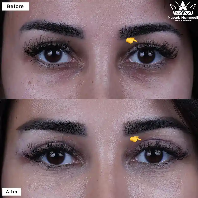 Upper Eyelid Blepharoplasty before and after Upper Blepharoplasty before after