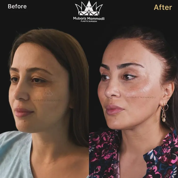 Endoscopic Facelift cost, before and after, benefits & more Endoscopic Facelift surgery