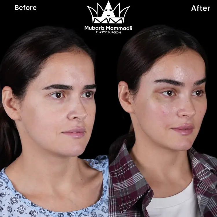 Endoscopic Facelift cost, Endoscopic Facelift before after