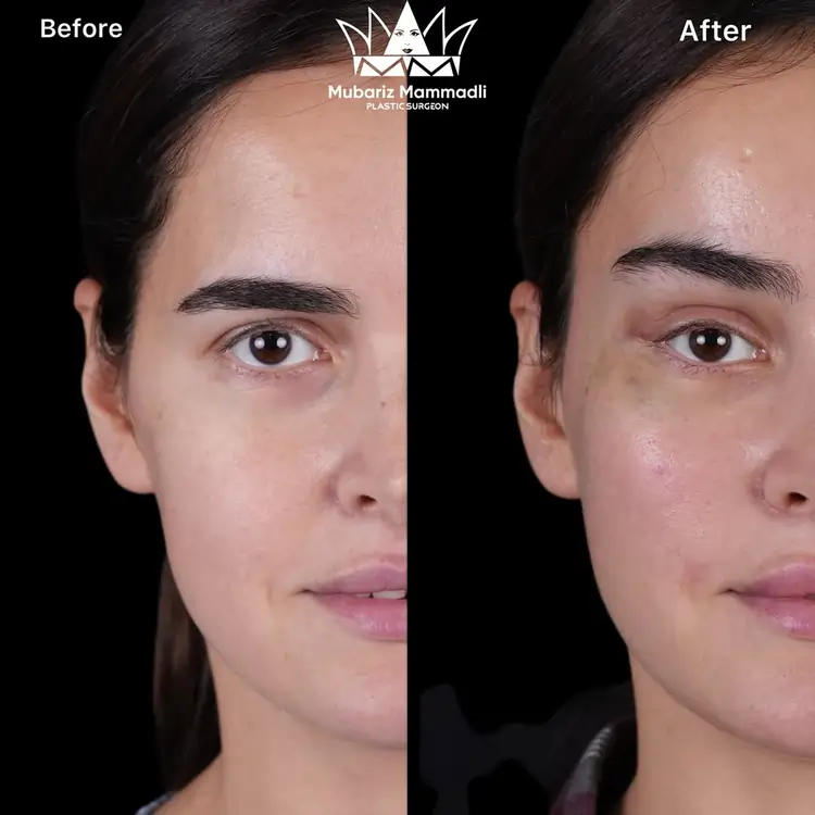 Endoscopic Facelift cost, Endoscopic Facelift before after