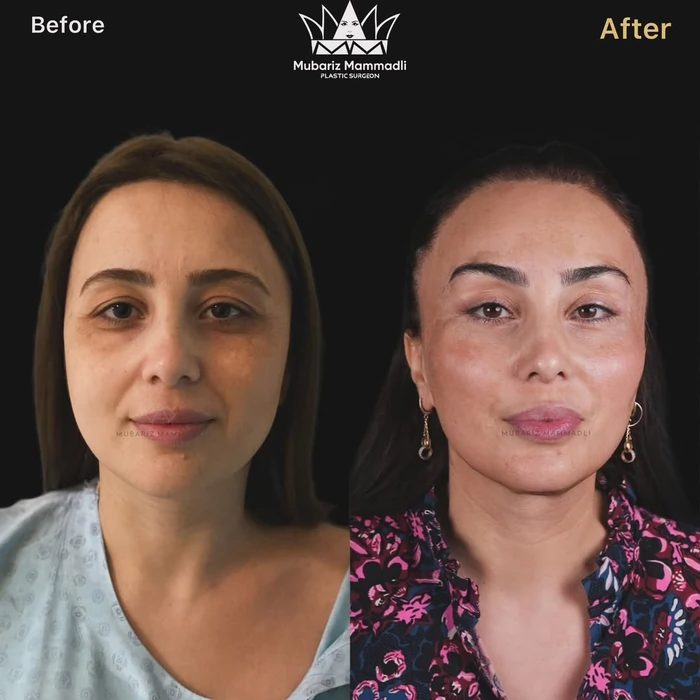 Endoscopic Facelift cost, Endoscopic Facelift before and after