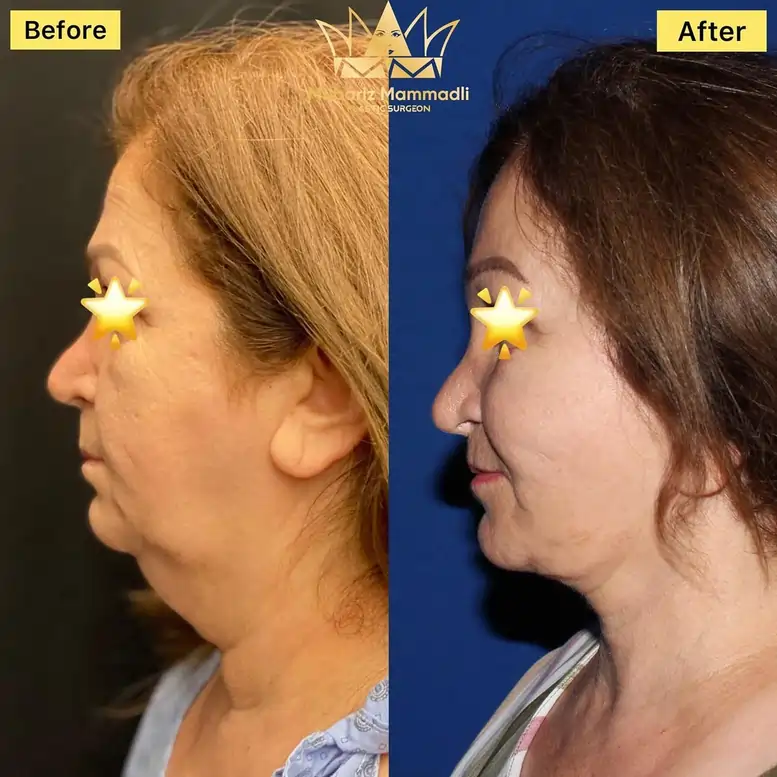 Endoscopic Forehead Lift before and after