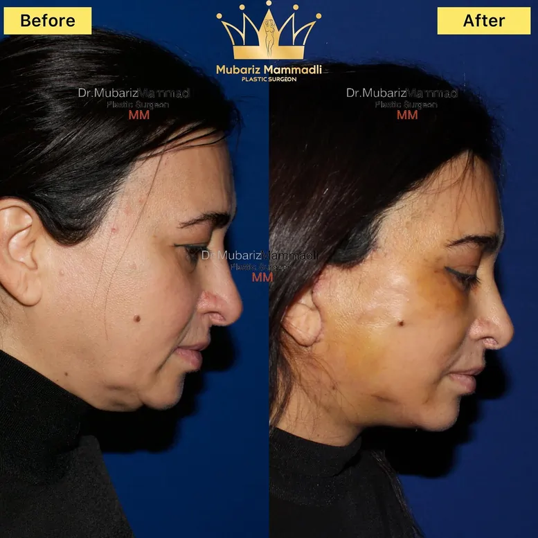 Endoscopic Forehead Lift before after images