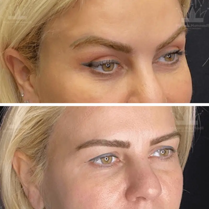 Endoscopic Forehead Lift cost. before and after, procedure and more