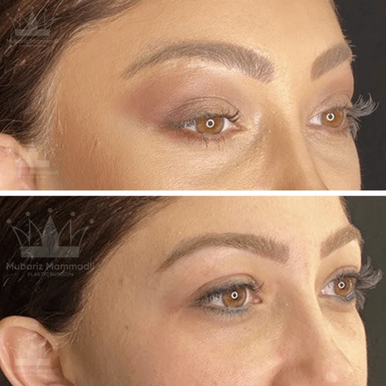 Endoscopic Forehead Lift before and after, procedure and more