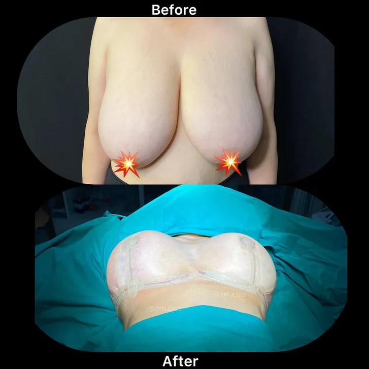 Breast Reduction Surgery before and after breast before after