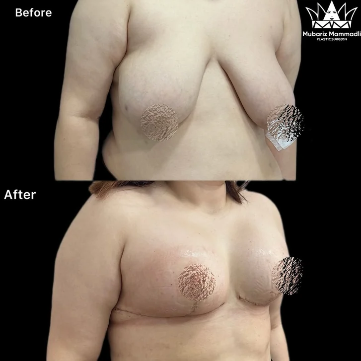 Breast Reduction Surgery before and after breast before after