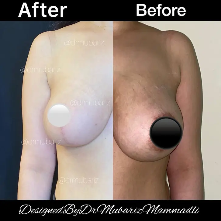 Breast Reduction Surgery before and after breast before after