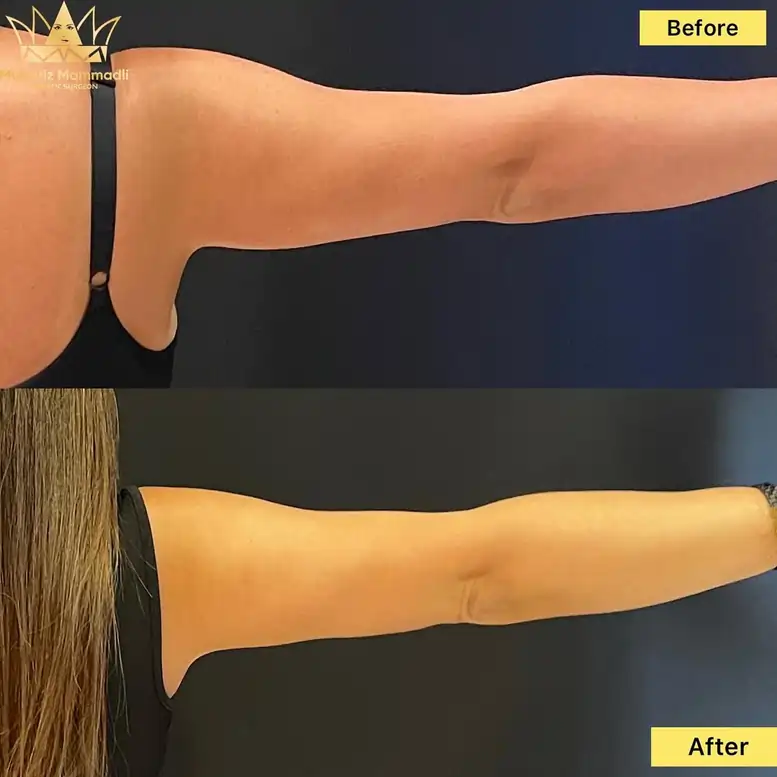 Arm Lift Surgery before and after, Arm Lift before after