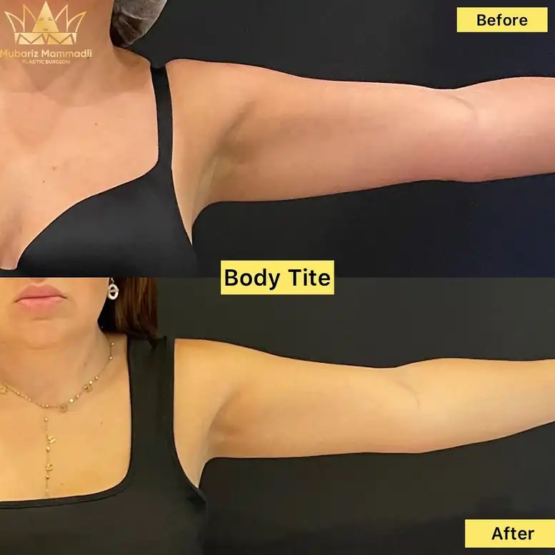 Arm Lift Surgery before and after, Arm Lift before after