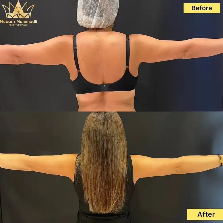 Arm Lift Surgery before and after, Arm Lift before after