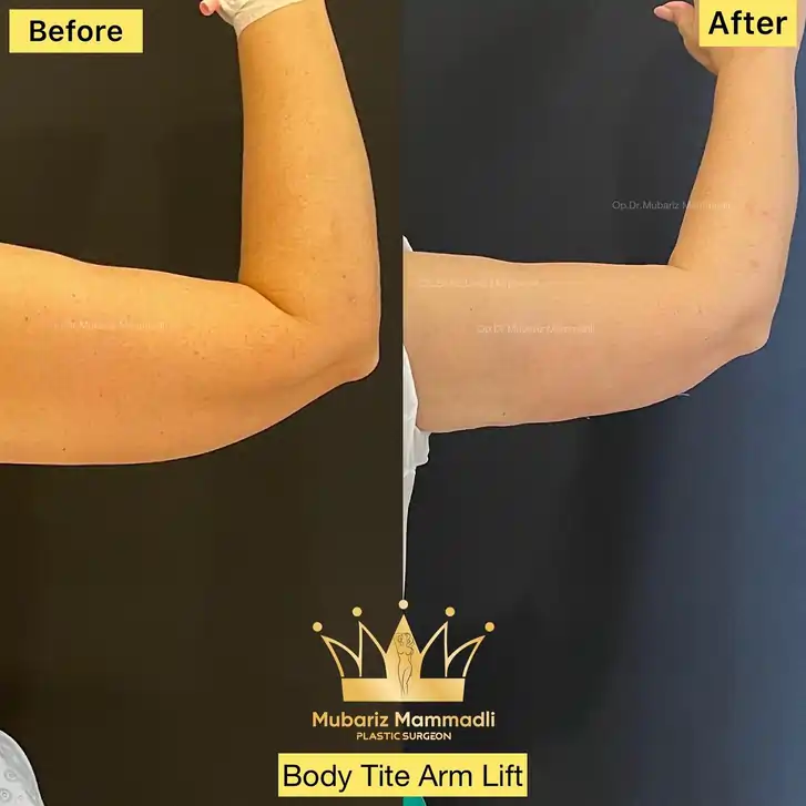 Arm Lift Surgery before and after, Arm Lift before after