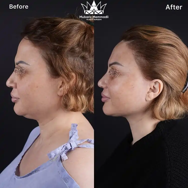 Neck Lift surgery before and after Neck Lift before after