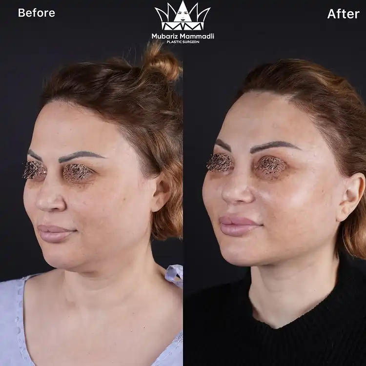 Neck Lift surgery before and after Neck Lift before after