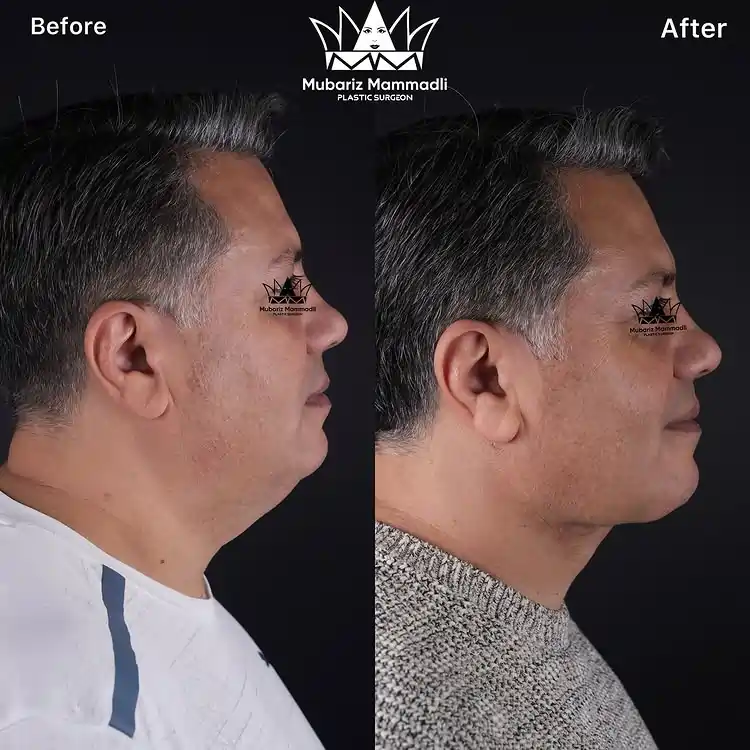 Neck Lift before and after Neck Lift surgery cost