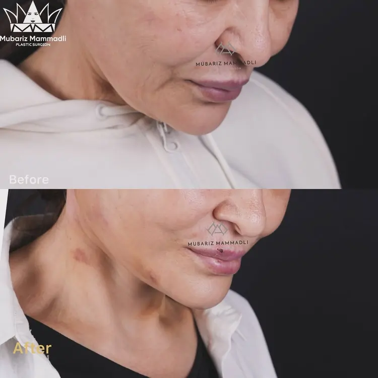 Neck Lift before and after Neck Lift surgery cost