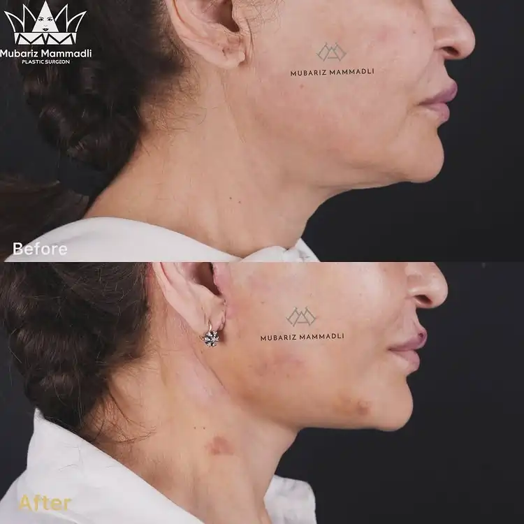 Neck Lift before and after Neck Lift surgery after